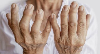 Descubrí qué es la artritis y cómo tratarla