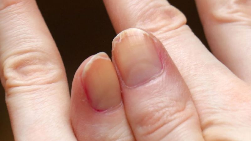 Vinagre: el remedio natural para decirle adiós a las manchas en las uñas