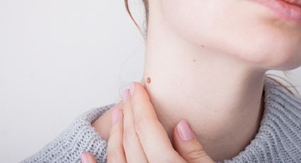 5 remedios caseros para eliminar las verrugas de las manos